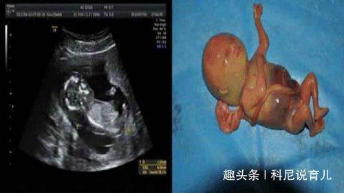 五大原因造成胎儿畸形的相关图片